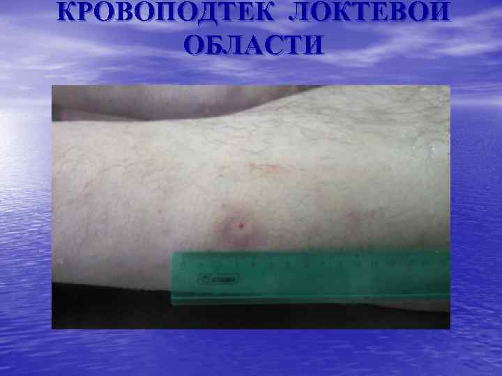 КРОВОПОДТЕК ЛОКТЕВОЙ ОБЛАСТИ 