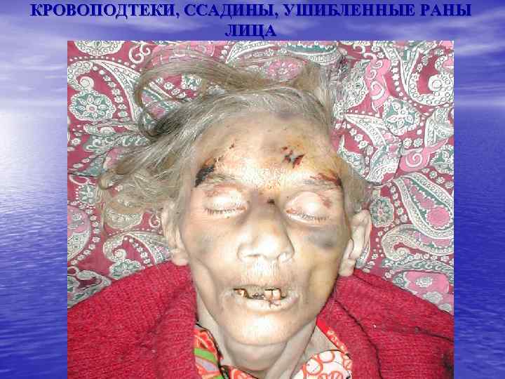 КРОВОПОДТЕКИ, ССАДИНЫ, УШИБЛЕННЫЕ РАНЫ ЛИЦА 
