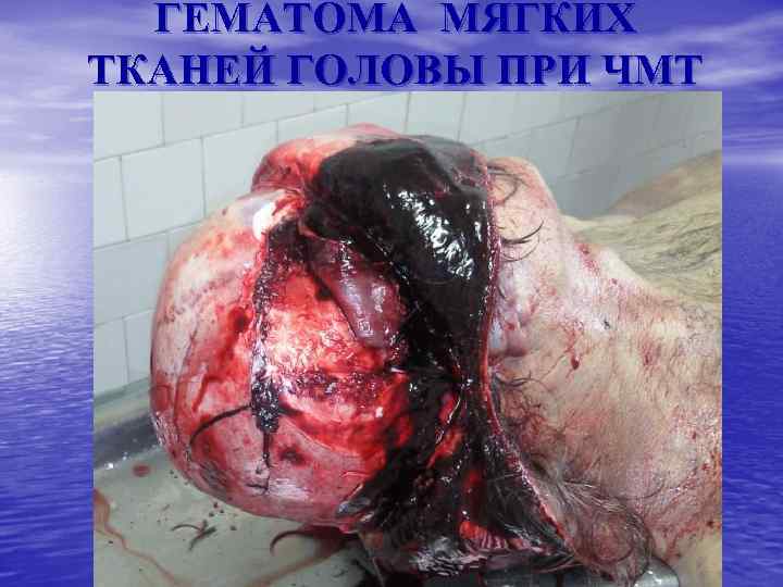 ГЕМАТОМА МЯГКИХ ТКАНЕЙ ГОЛОВЫ ПРИ ЧМТ 