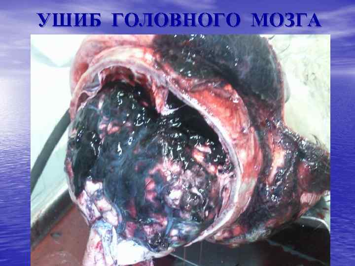 УШИБ ГОЛОВНОГО МОЗГА 