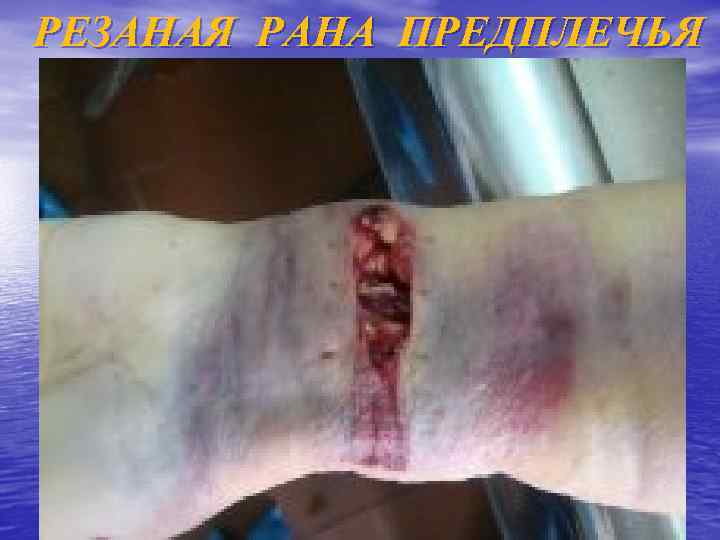 РЕЗАНАЯ РАНА ПРЕДПЛЕЧЬЯ 