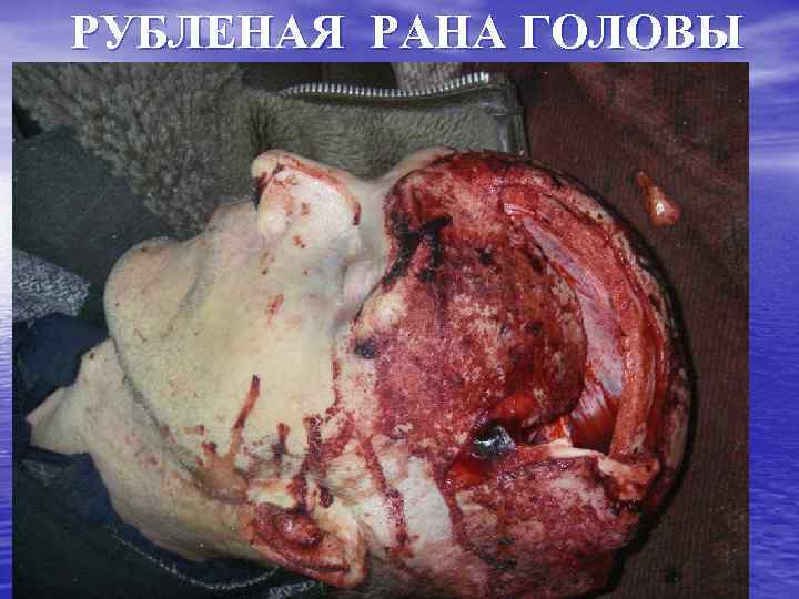 РУБЛЕНАЯ РАНА ГОЛОВЫ 