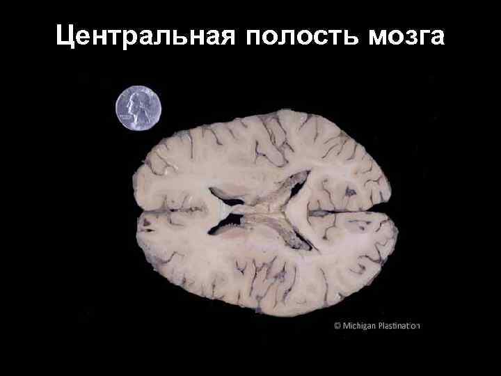 Центральная полость мозга 