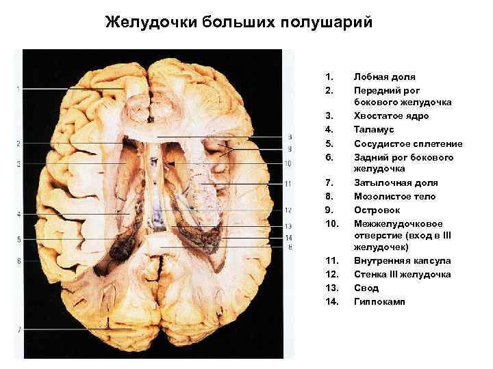 Размеры боковых желудочков мозга