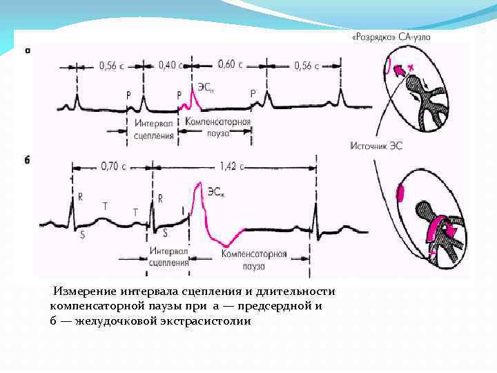 Компенсаторная пауза. Компенсаторная пауза при экстрасистолии. Кордарон при желудочковой экстрасистолии. Тест предсердной стимуляции.