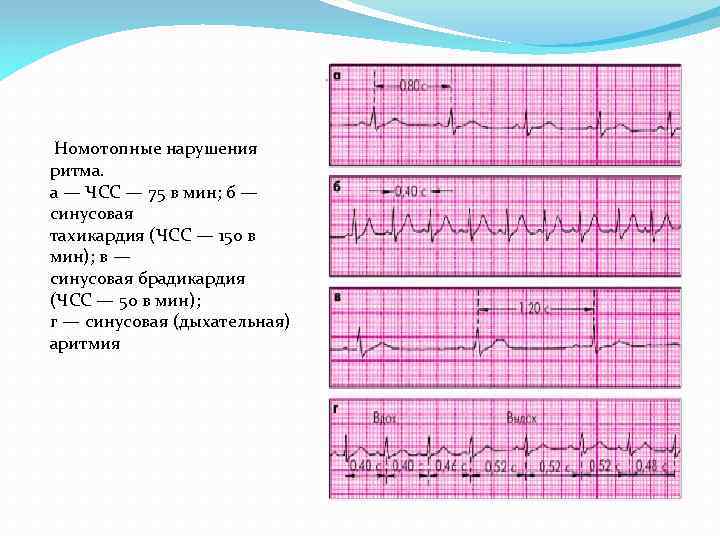 Умеренная синусовая брадикардия у ребенка. Синусовая брадикардия на ЭКГ. Номотопный водитель ритма синусовая аритмия что это такое. Дыхательная аритмия на ЭКГ. Синусовая тахикардия ЧСС.