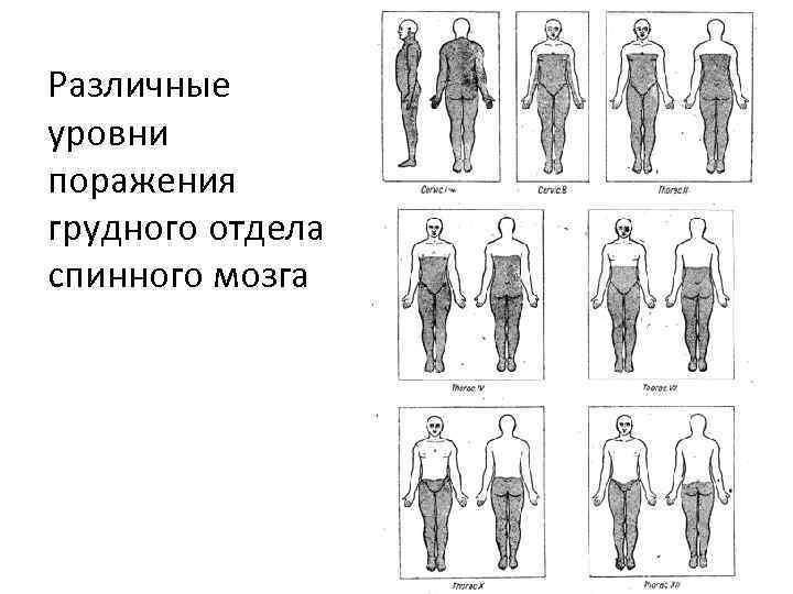 Различные уровни поражения грудного отдела спинного мозга 