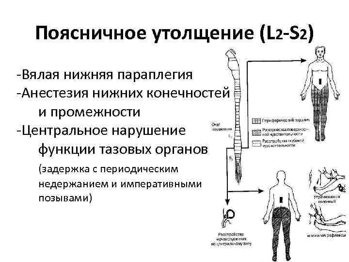 Поясничное утолщение (L 2 -S 2) -Вялая нижняя параплегия -Анестезия нижних конечностей и промежности