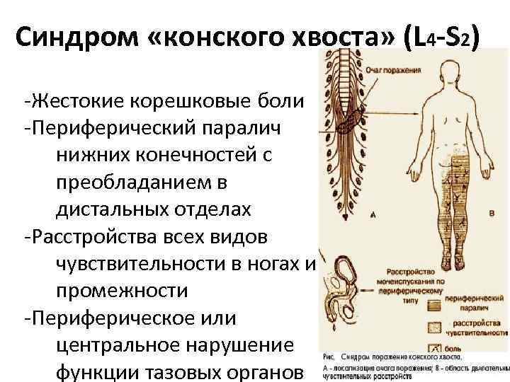 Синдром «конского хвоста» (L 4 -S 2) -Жестокие корешковые боли -Периферический паралич нижних конечностей