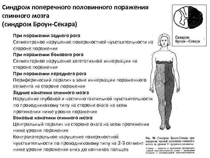 Синдром поперечного половинного поражения спинного мозга (синдром Броун-Секара) При поражении заднего рога Сегментраное нарушение