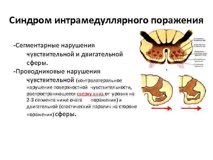 Синдром интрамедуллярного поражения -Сегментарные нарушения чувствительной и двигательной сферы. -Проводниковые нарушения чувствительной (контралатеральное нарушение