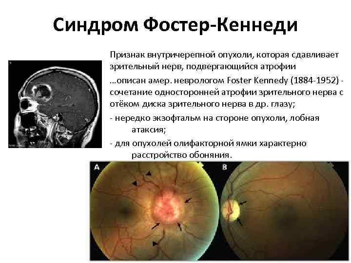 Синдром Фостер-Кеннеди Признак внутричерепной опухоли, которая сдавливает зрительный нерв, подвергающийся атрофии …описан амер. неврологом