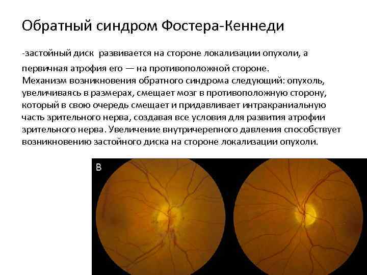 Обратный синдром Фостера-Кеннеди -застойный диск развивается на стороне локализации опухоли, а первичная атрофия его