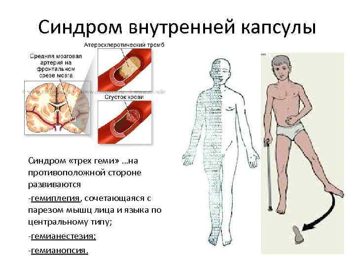 Синдром внутренней капсулы Синдром «трех геми» …на противоположной стороне развиваются -гемиплегия, сочетающаяся с парезом