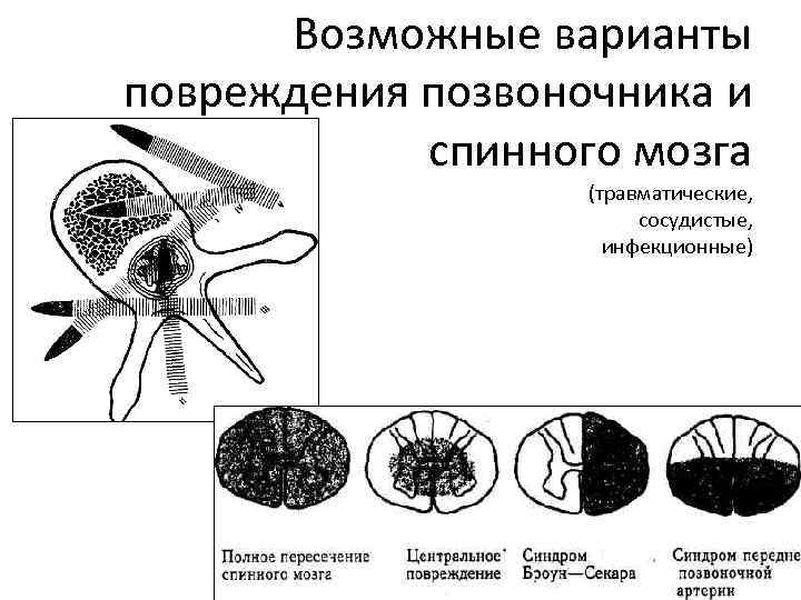 Возможные варианты повреждения позвоночника и спинного мозга (травматические, сосудистые, инфекционные) 