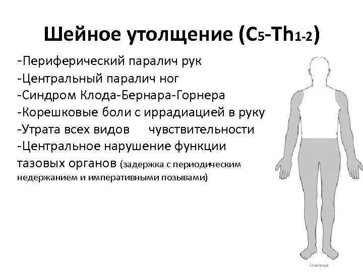 Шейное утолщение (C 5 -Th 1 -2) -Периферический паралич рук -Центральный паралич ног -Синдром