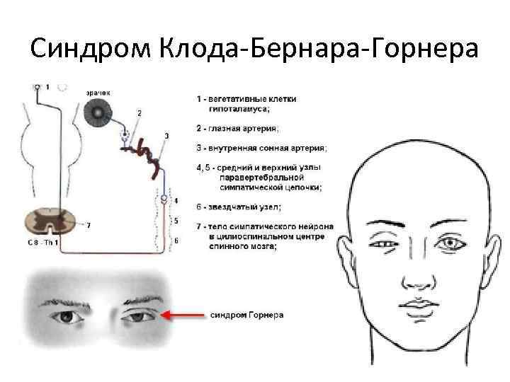 Синдром Клода-Бернара-Горнера 