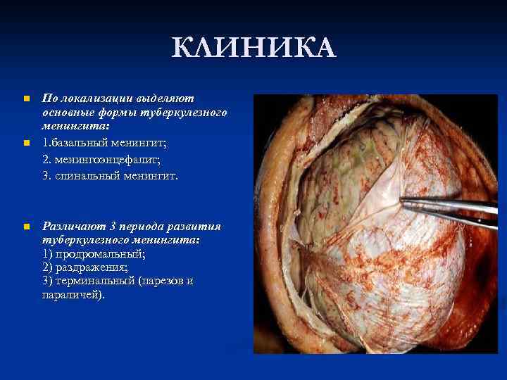 КЛИНИКА По локализации выделяют основные формы туберкулезного менингита: n 1. базальный менингит; 2. менингоэнцефалит;