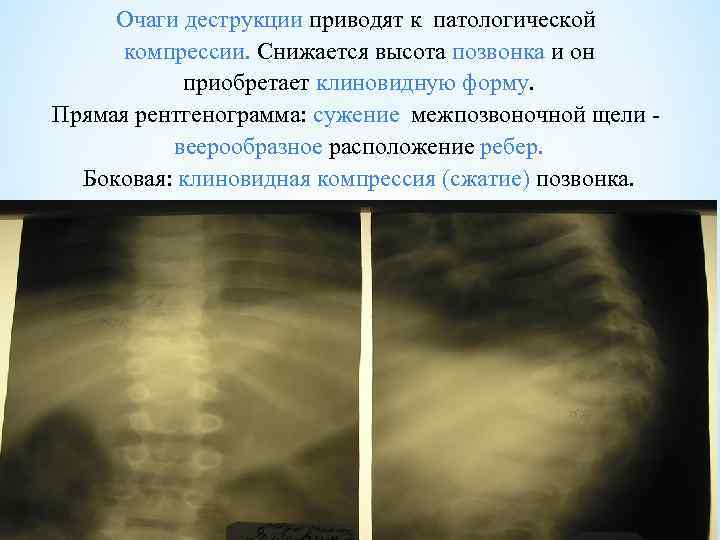 Очаги деструкции приводят к патологической компрессии. Снижается высота позвонка и он приобретает клиновидную форму.