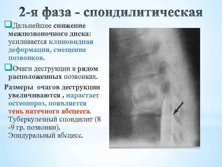 q. Дальнейшее снижение межпозвоночного диска: усиливается клиновидная деформация, смещение позвонков. q. Очаги деструкции в