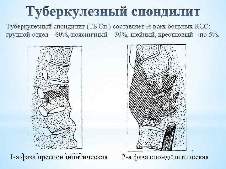 Туберкулезный спондилит (ТБ Сп. ) составляет ½ всех больных КСС: грудной отдел – 60%,