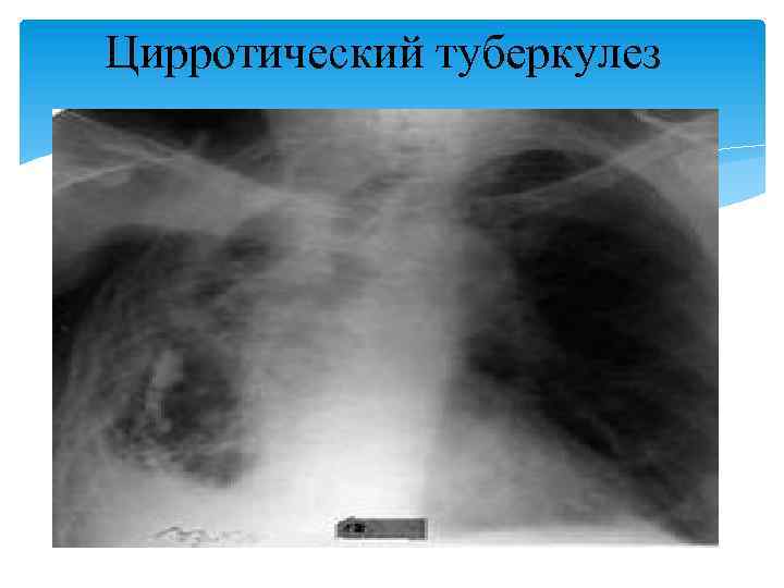 Цирротический туберкулез 