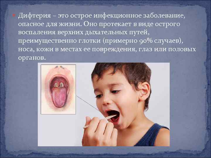  Дифтерия – это острое инфекционное заболевание, опасное для жизни. Оно протекает в виде