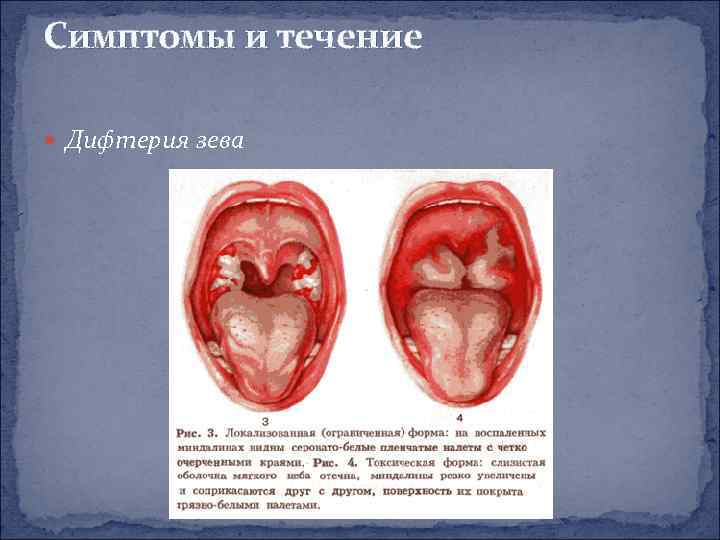 Симптомы и течение Дифтерия зева 
