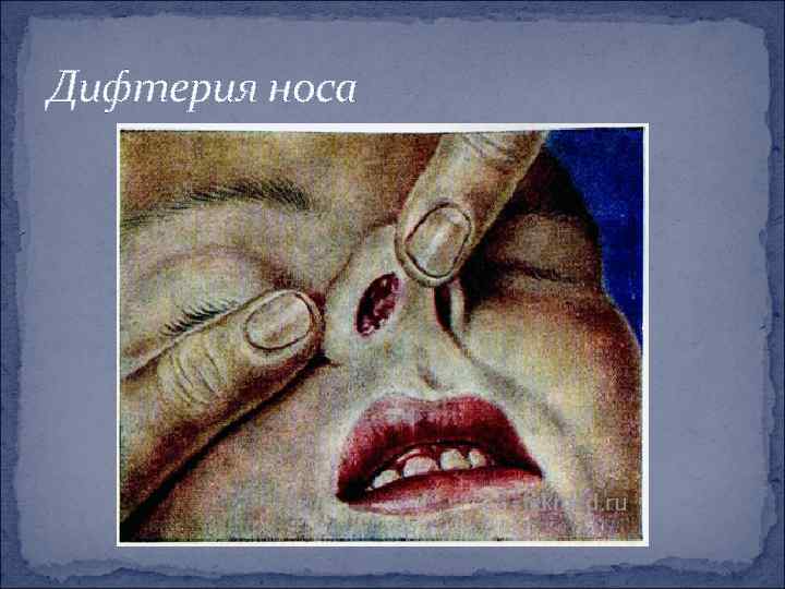 Дифтерия носа 