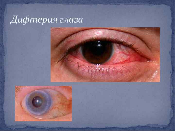 Дифтерия глаза 