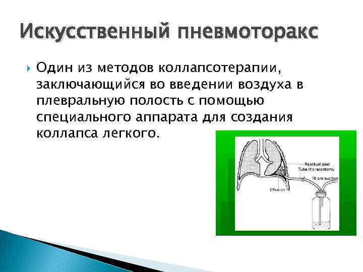 Искусственный пневмоторакс Один из методов коллапсотерапии, заключающийся во введении воздуха в плевральную полость с