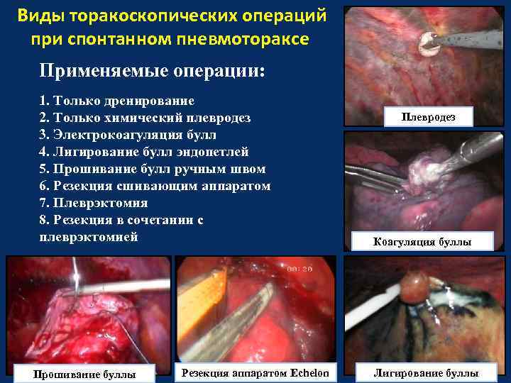 Виды торакоскопических операций при спонтанном пневмотораксе Применяемые операции: 1. Только дренирование 2. Только химический