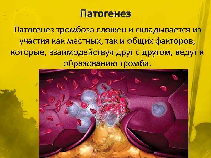 Механизмы тромбов. Патогенез образования тромба. Этиология тромбоза. Патогенез тромбообразования. Патогенез флеботромбоза.