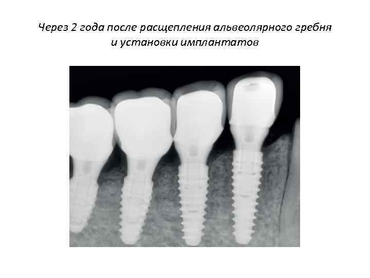 Через 2 года после расщепления альвеолярного гребня и установки имплантатов 