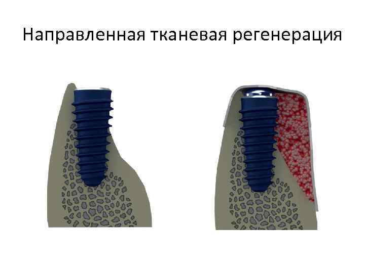 Направленная тканевая регенерация 