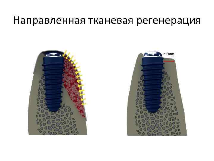 Направленная костная регенерация презентация