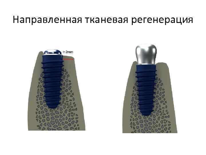 Направленная костная регенерация презентация