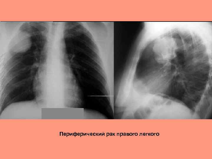 Периферический рак правого легкого 