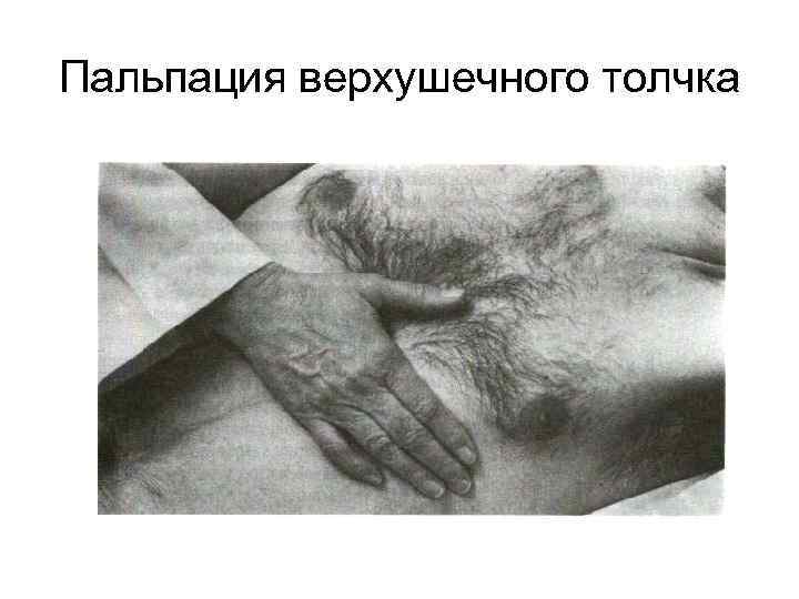 Пальпация верхушечного толчка 