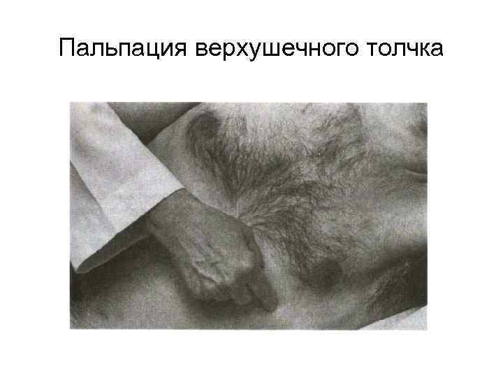 Пальпация верхушечного толчка 