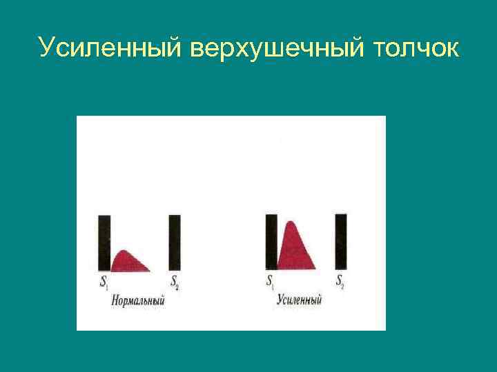 Усиленный верхушечный толчок 