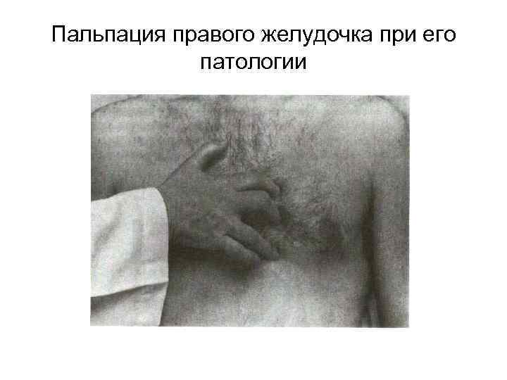 Пальпация правого желудочка при его патологии 