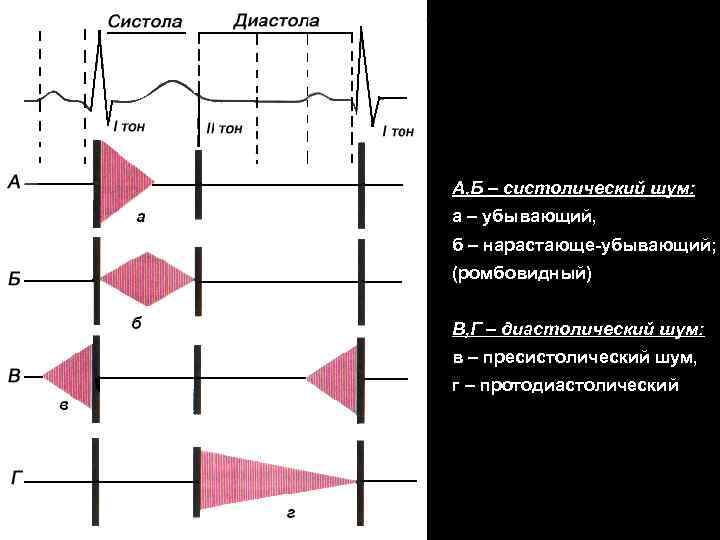 А, Б – систолический шум: а – убывающий, б – нарастающе-убывающий; (ромбовидный) В, Г