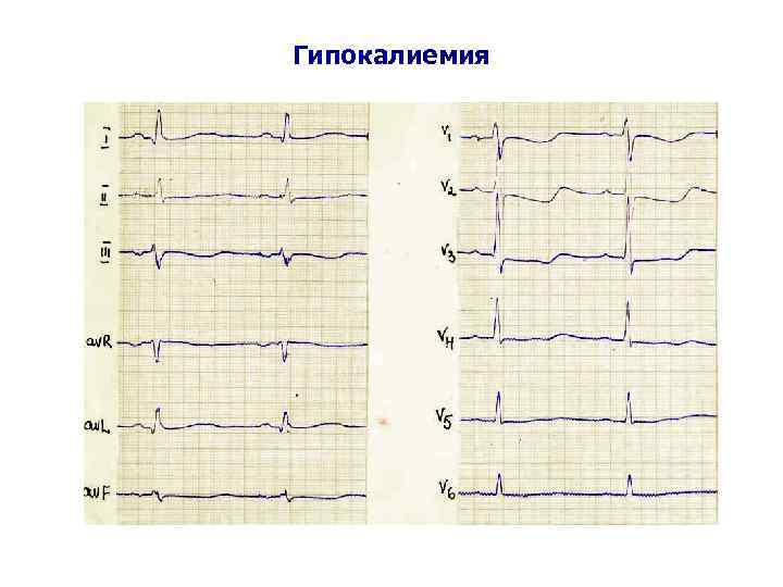 Гипокалиемия 