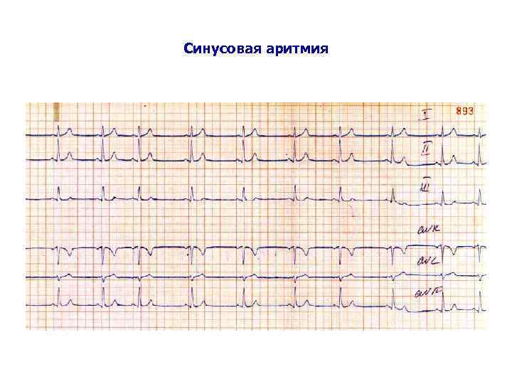 Синусовая аритмия 