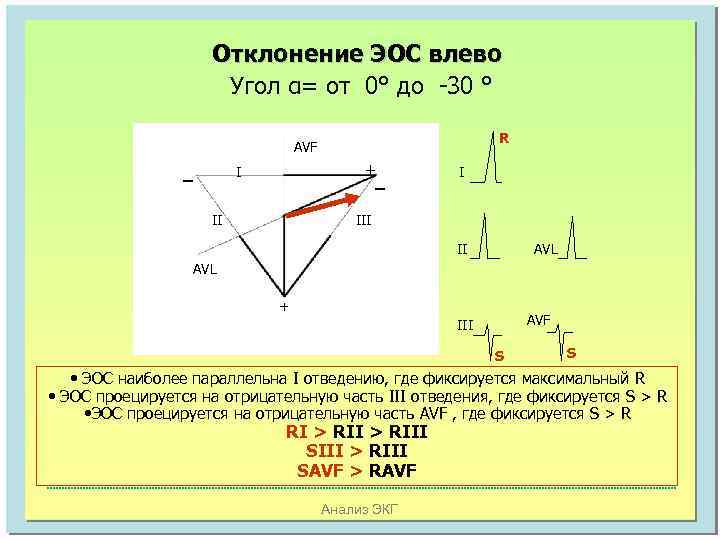 Отклонение ЭОС влево Угол α= от 0° до -30 ° R AVF _ +