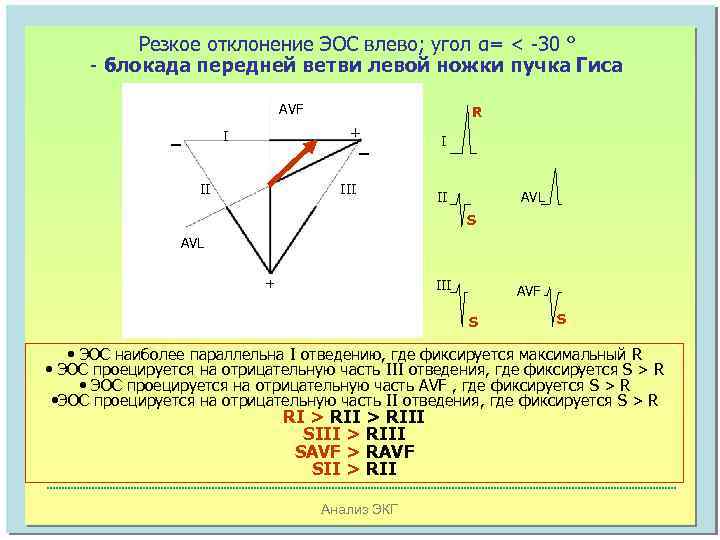 Резкое отклонение ЭОС влево; угол α= < -30 ° - блокада передней ветви левой