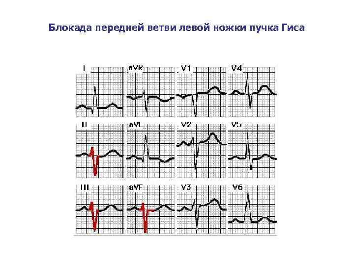 Блокада передней ветви левой ножки пучка Гиса 
