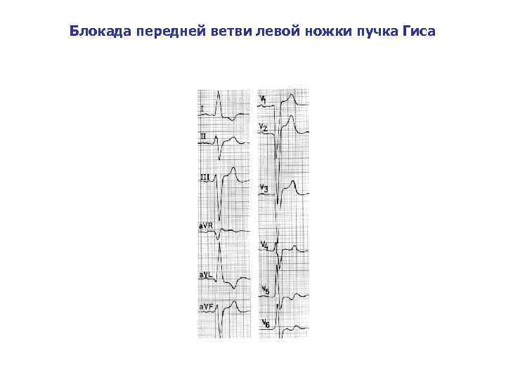 Блокада передней ветви левой ножки пучка Гиса 