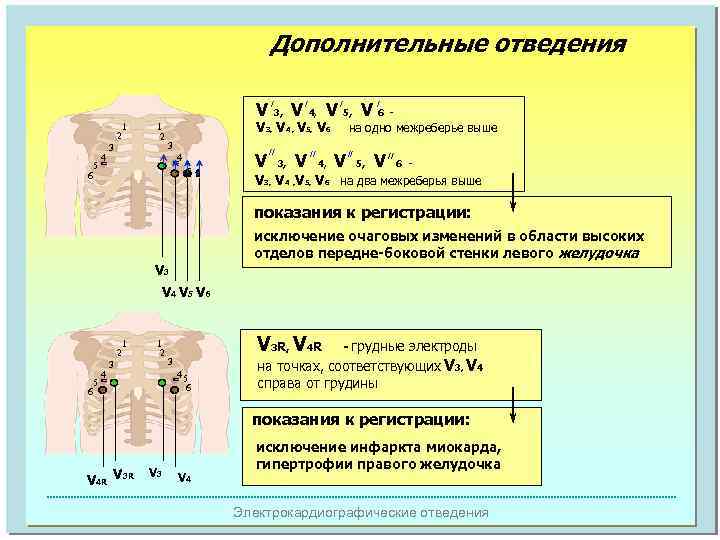 Дополнительные отведения V 3, V 4, V 5, V 6 / 1 2 3
